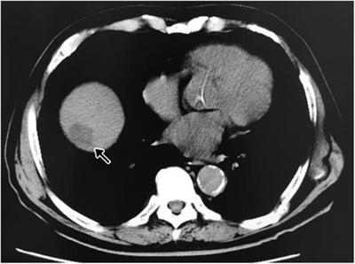 Case report: Ectopic thyroid tissue found in a liver with hepatocellular carcinoma